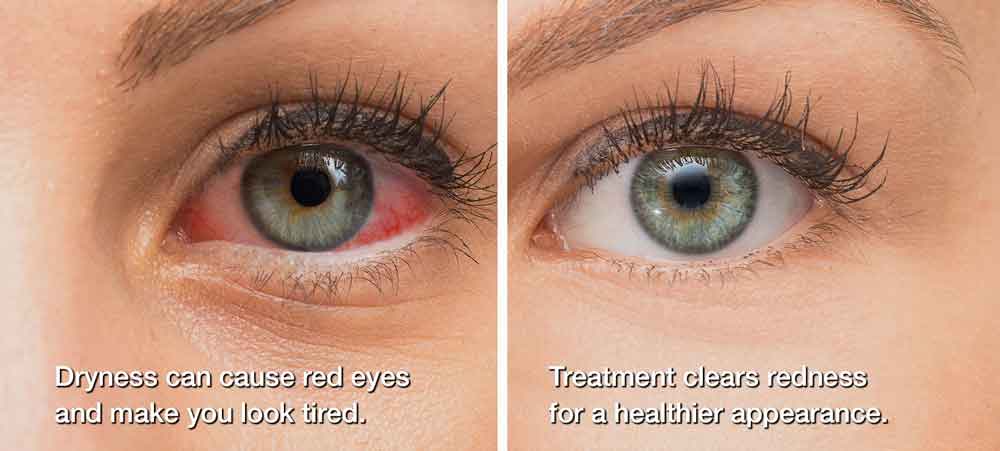 A before and after photo of a woman with red, dry eyes stating: dryness can cause red eyes and make you look tired. Treatment clears redness for a healthier appearance.